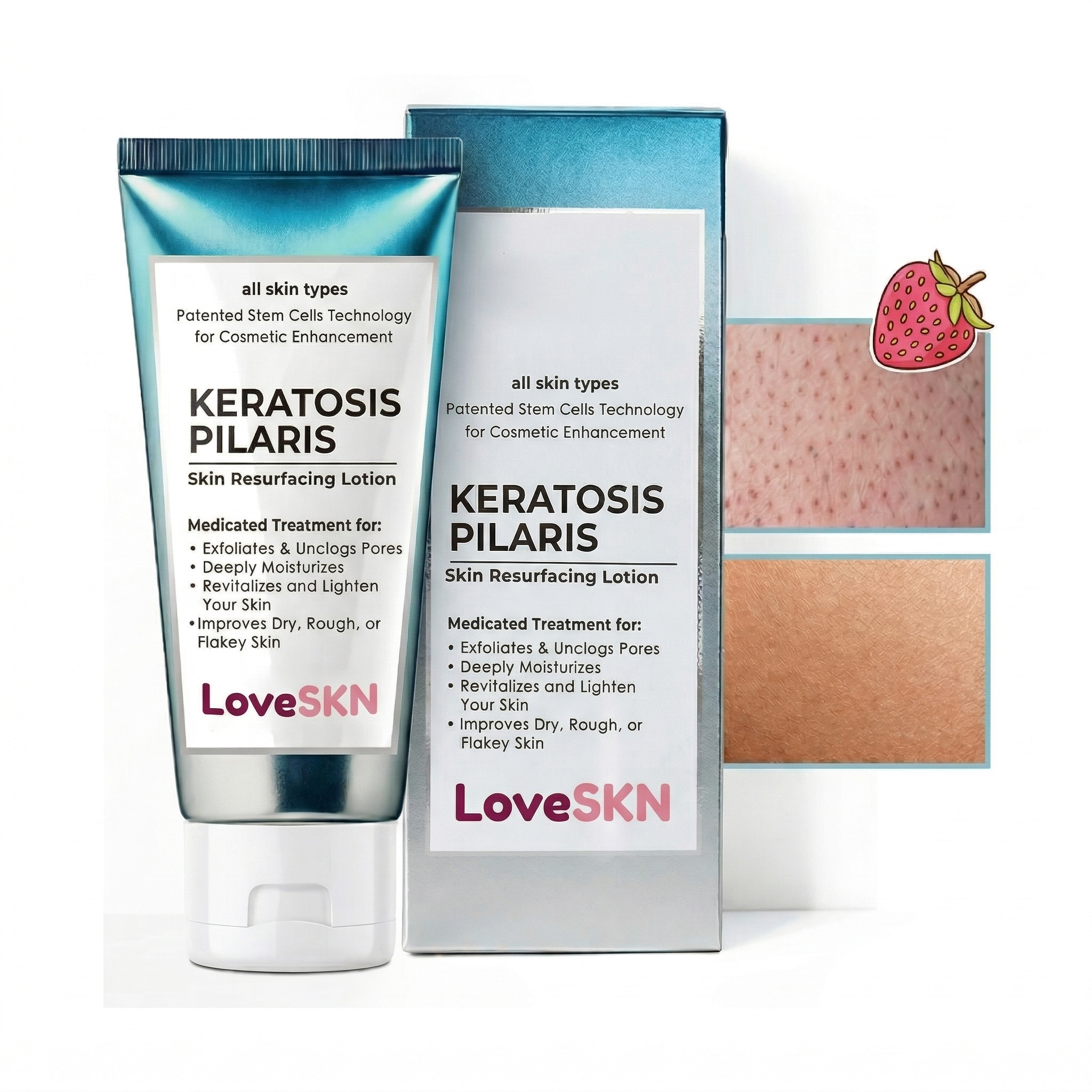 LoveSKN™ - Skin Resurfacing Lotion for Keratosis Pilaris