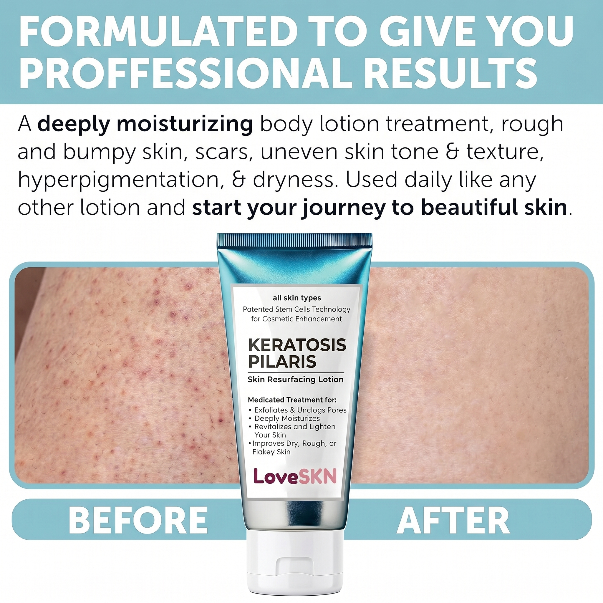 LoveSKN™ - Skin Resurfacing Lotion for Keratosis Pilaris