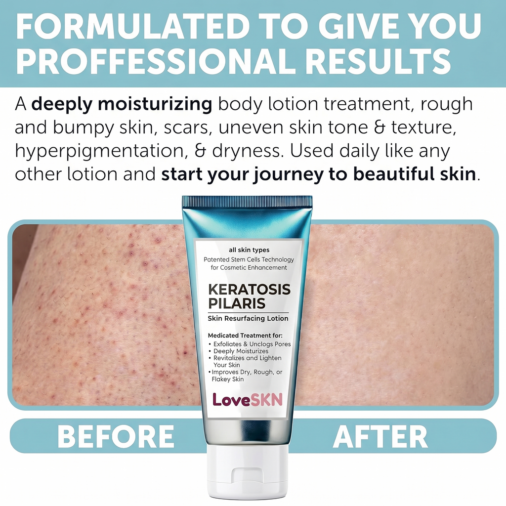 LoveSKN™ - Skin Resurfacing Lotion for Keratosis Pilaris