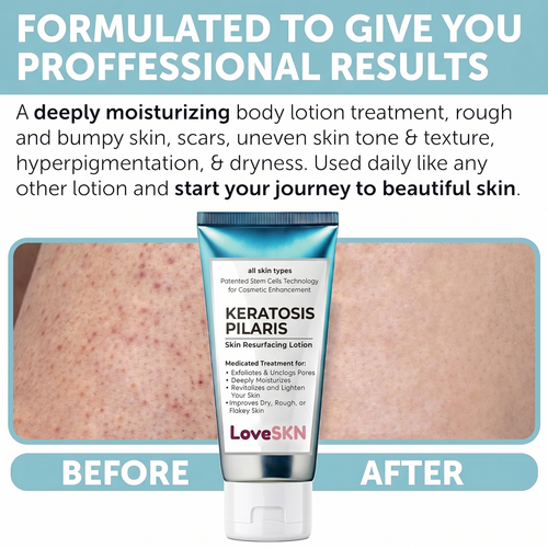 LoveSKN™ - Skin Resurfacing Lotion for Keratosis Pilaris