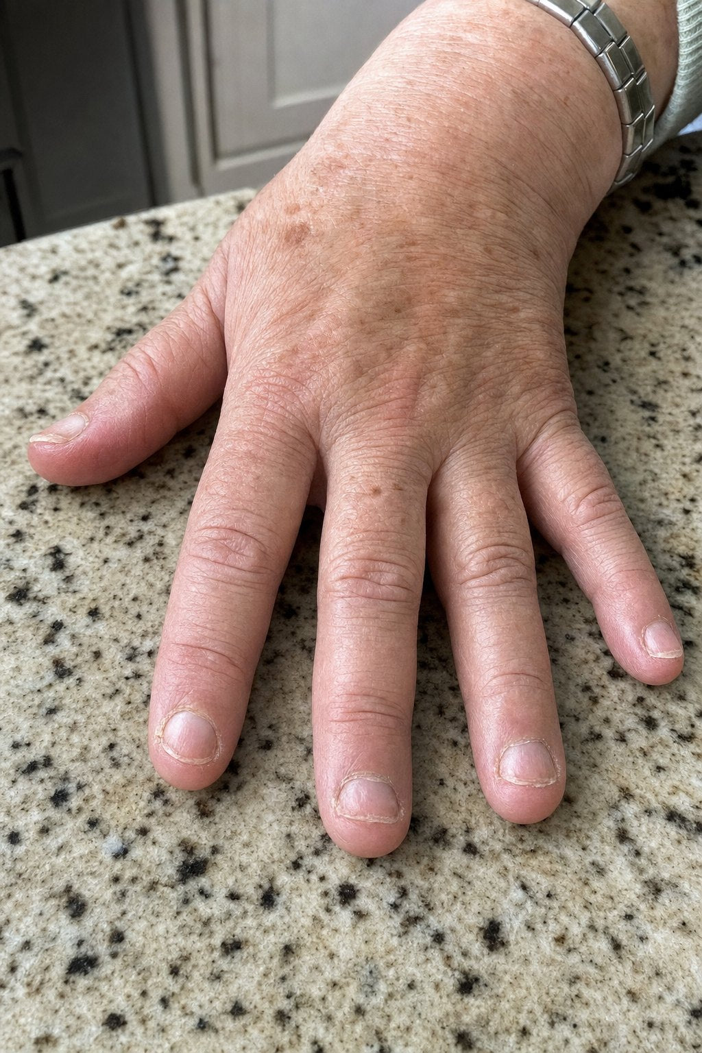 Short bitten nails